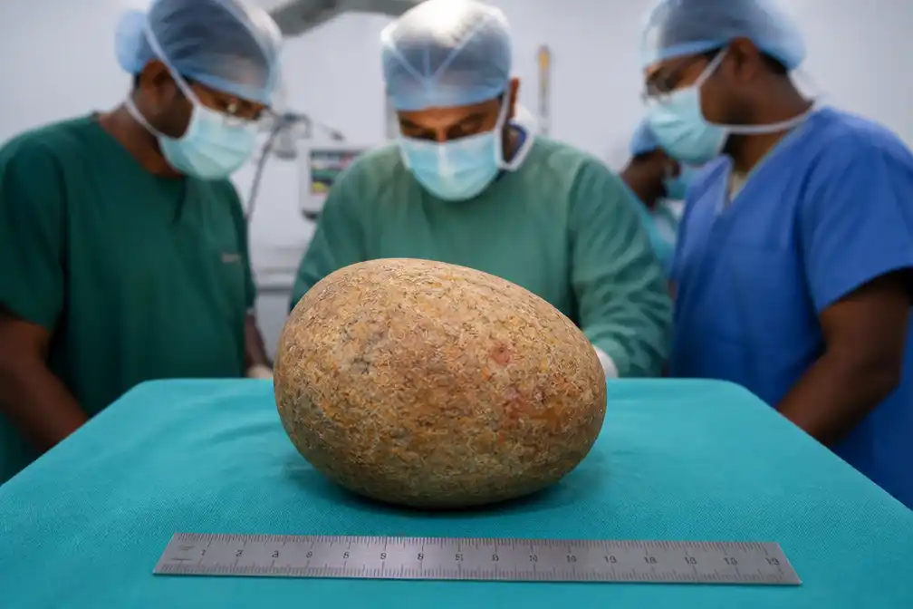 Chirurgen Sri Lanka verwijderen blaassteen van 3,1 kilo, mogelijk record