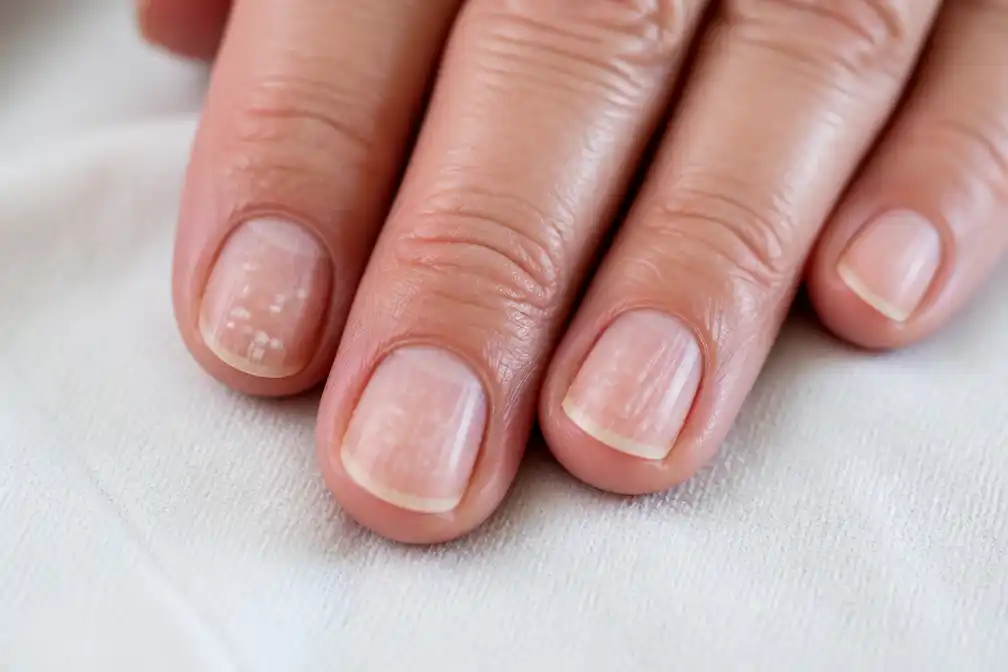 Medisch pedicure legt uit wat vlekjes en groeven in nagels over gezondheid zeggen